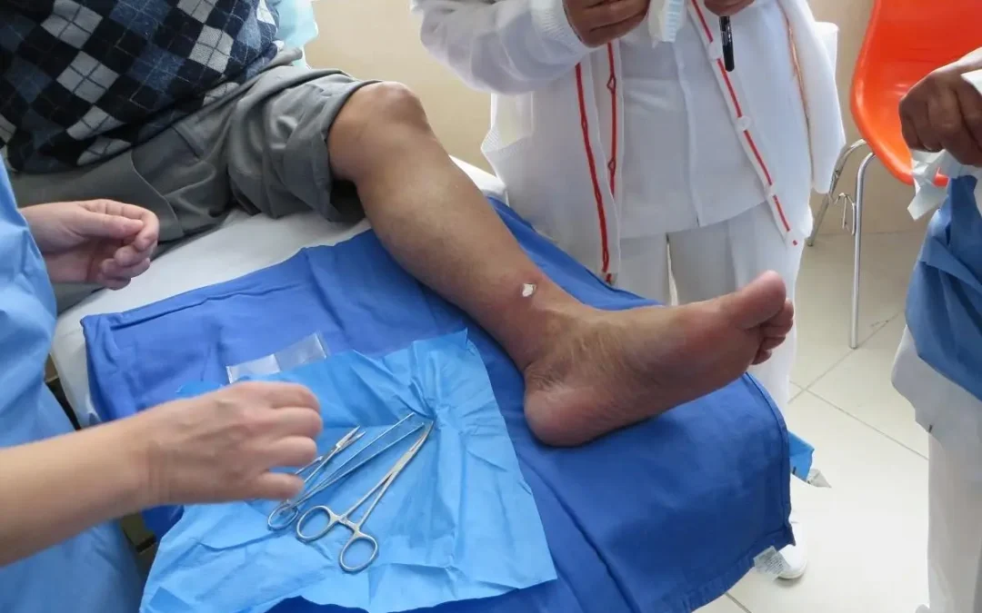 Curación Avanzada: La mejor opción para heridas complejas