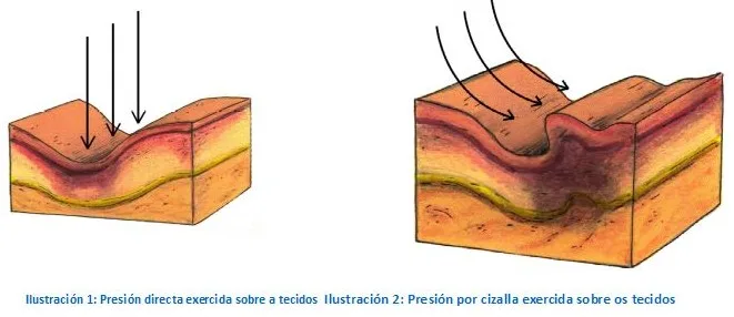 presion-escara-ulcera-por-presión