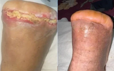 Pie diabetico: Caso Clinico Paciente con amputación de ortejos en pie