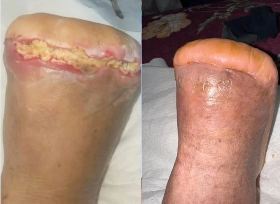 Pie diabetico: Caso Clinico Paciente con amputación de ortejos en pie