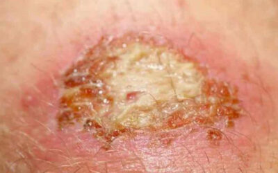 Herida infectada: cómo reconocerla, tratarla y prevenir complicaciones