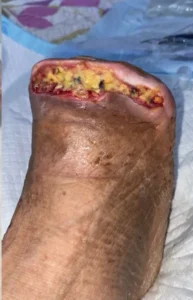 pie-diabetico-esfacelo