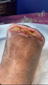 pie-diabetico-caso-clinico-curacare