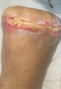 caso-pie-diabetico-curacion-avanzada