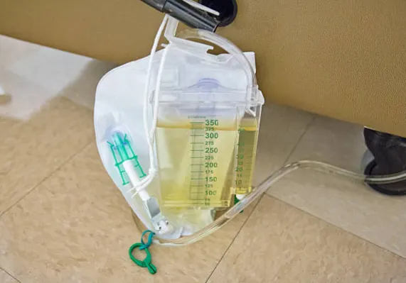 Sonda Foley: Uso, cuidados y recomendaciones para pacientes y familiares