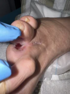 pie-diabetico-caso-clinico-curacare-6