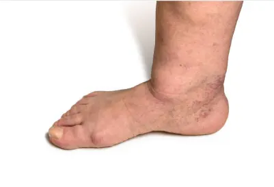 pie-diabetico-curacare