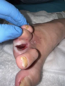 caso-clinico-pie-diabetico-5