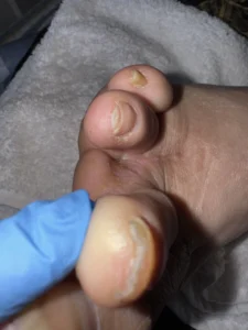 pie-diabetico-caso-clinico-7