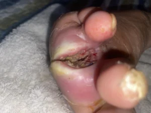 pie-diabetico-caso-clinico-curacare