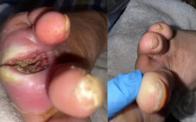 Caso clínico: Curación avanzada en paciente diabética con amputación de ortejo