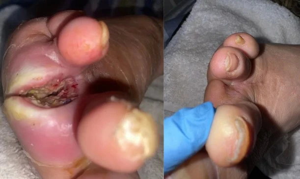 Caso clínico: Curación avanzada en paciente diabética con amputación de ortejo